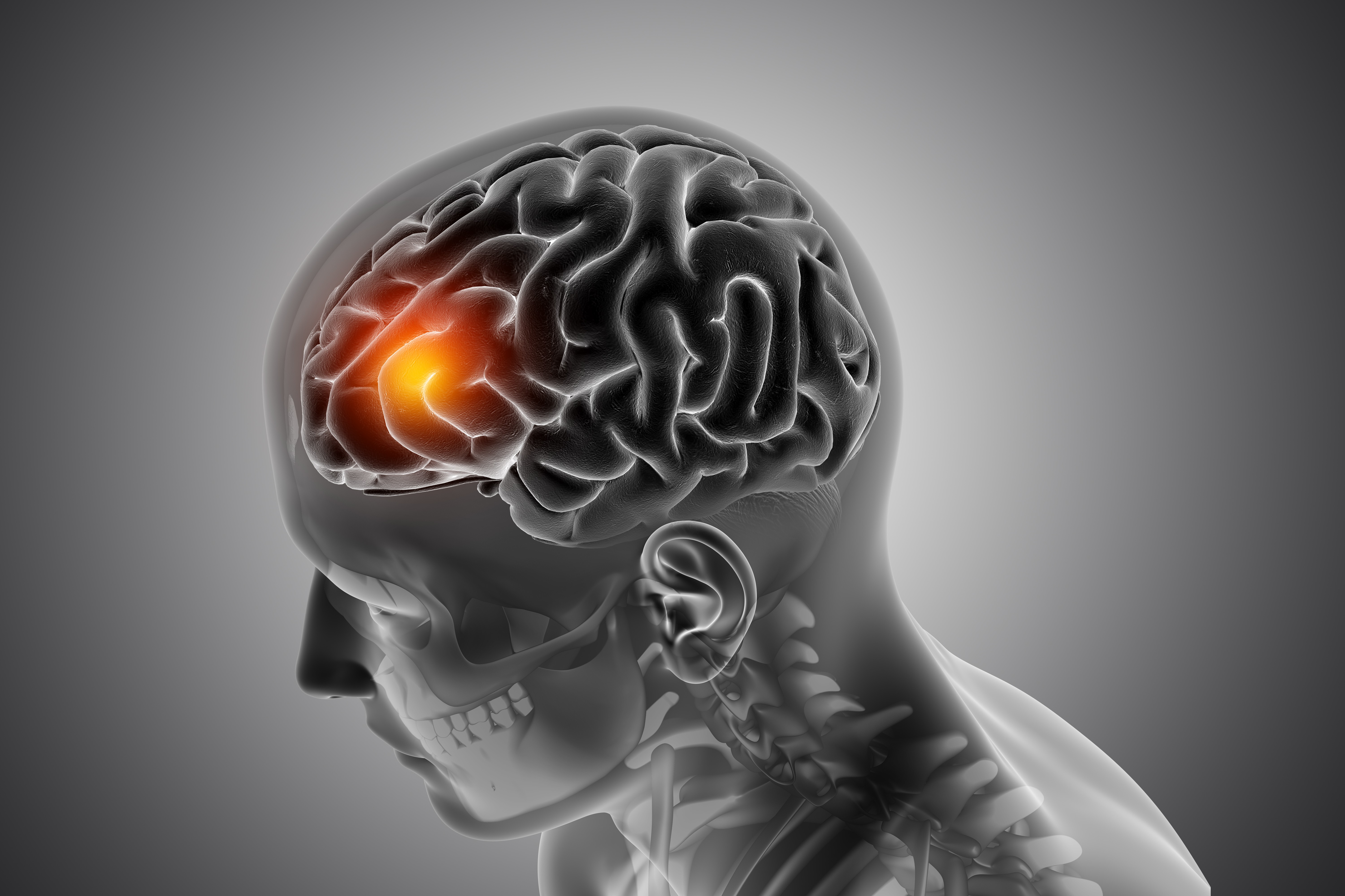 Medical illustration or scan of a brain tumor