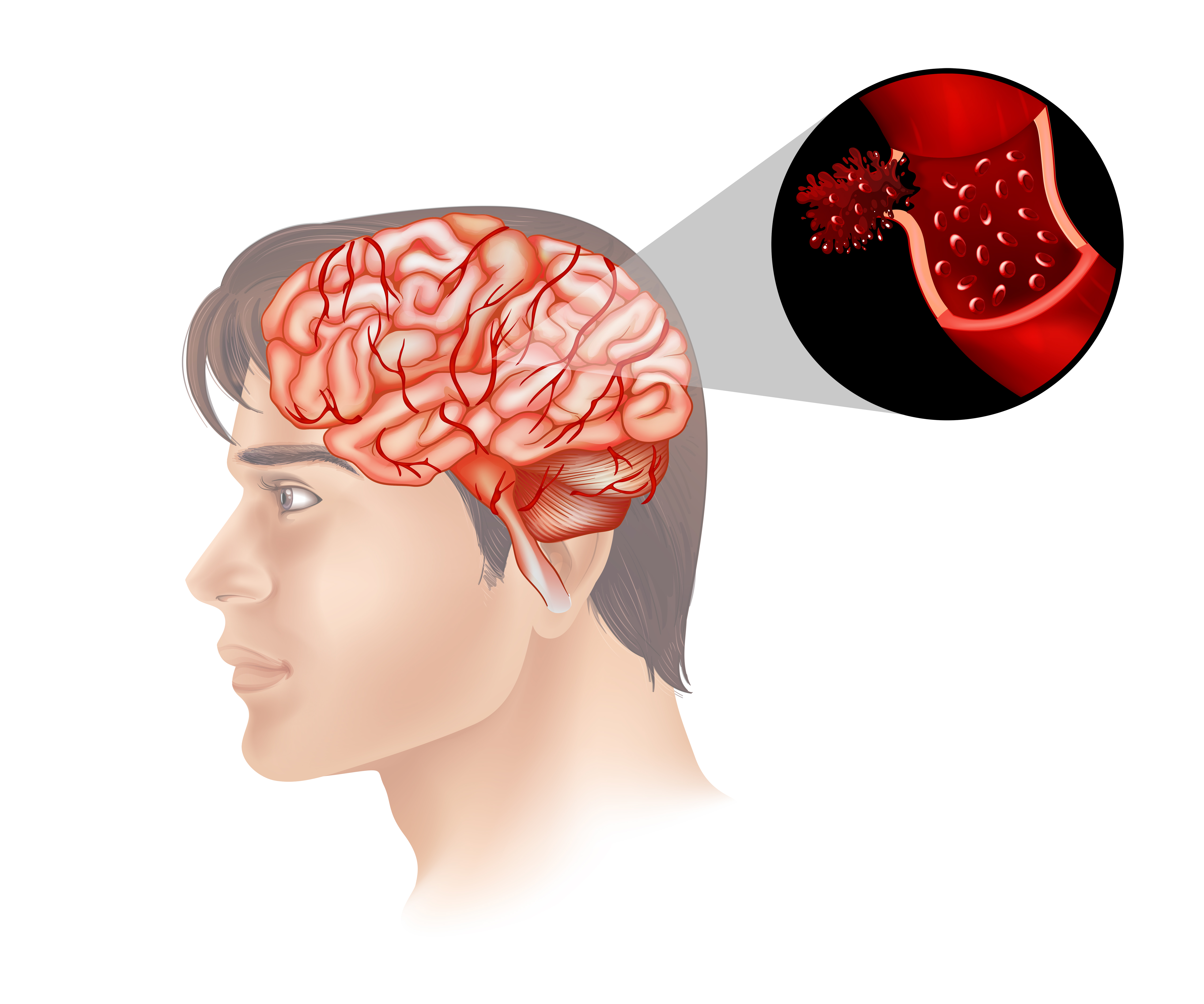 Stroke Treatment